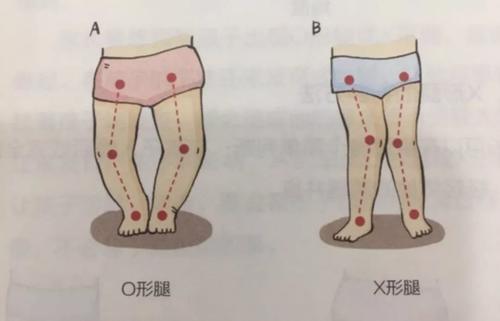 宝宝x型腿,o型腿,还能恢复吗?