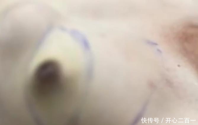 乳腺里有个小疙瘩会跑