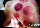 比薏米去湿气强千倍的它20年湿气一次去光,效果好7天瘦10斤