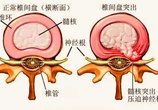 腰椎间盘突出症到底可不可以做推拿治疗?