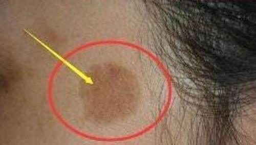 脸上长了“老年斑”，牙膏加上它，不仅祛斑还净化黑头