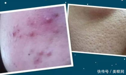 「粗大」还在为毛孔粗大而烦恼吗?集美们,看过来,这样做让你的肌肤细嫩无瑕!