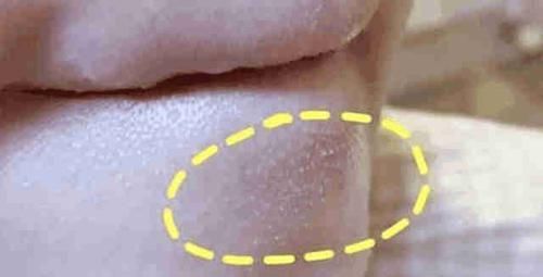  皮肤：抿嘴后下巴毛孔凸起“白米粒”! 原来是这几个东西, 2方法速去