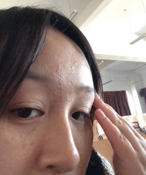 许多人不知道螨虫怕什么,3招皮肤变成“无痘肌”