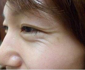 面部皱纹是皮肤一大难题!找出原因，才能对症治疗