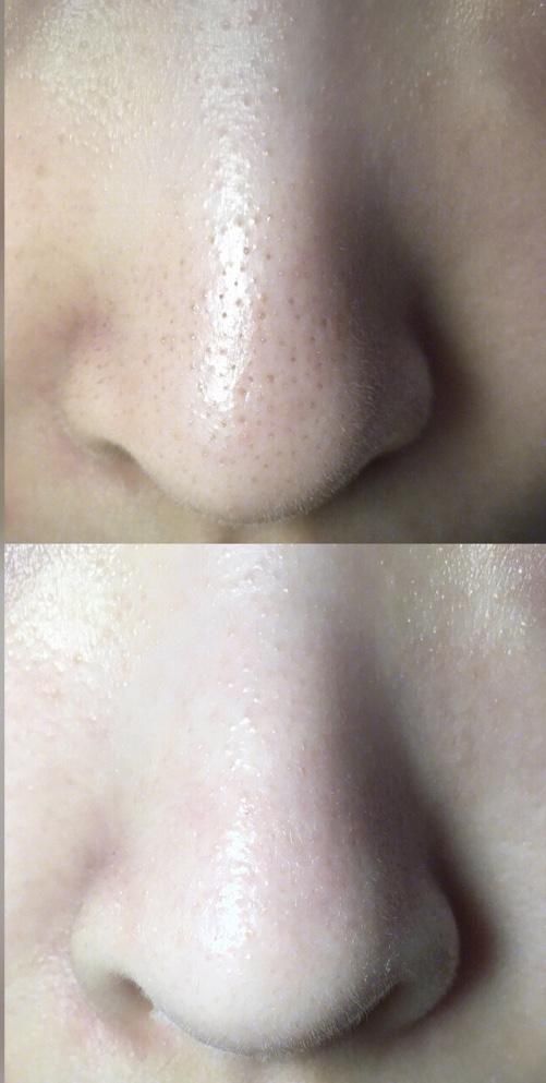 便宜好用不伤皮肤的去黑头方法，你现在才知道？