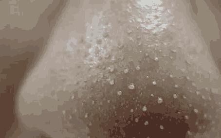 鼻子两侧挤出黄色条状物都逃不出这4种，总有一种符合你，2招吸净