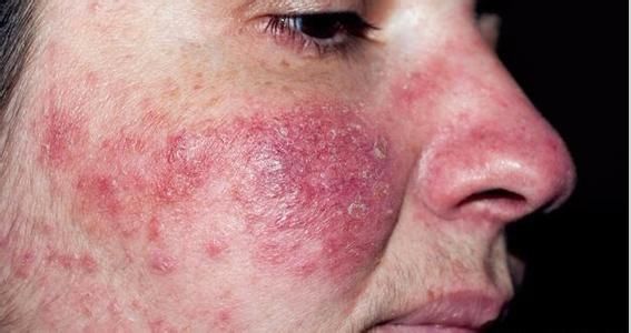 晨起脸上有这3个表现，不好意思，百万螨虫大军在脸上“做窝”了