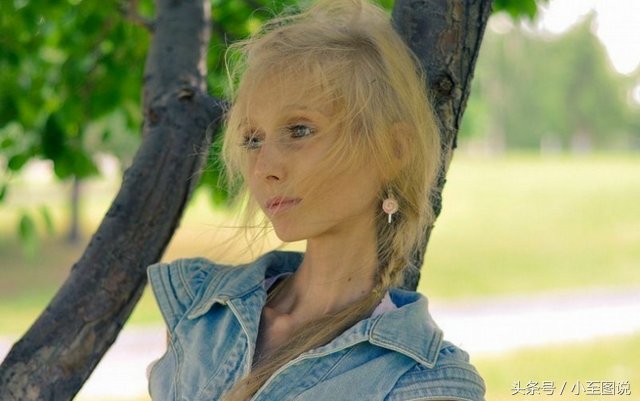 俄罗斯女子为减肥变成活骷髅，体重只剩42斤