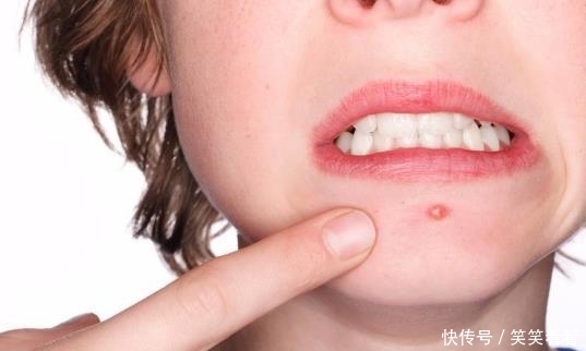 『女性』红霉素睡前抹一抹,醒来皮肤“重回十八”,尤其女性要了解
