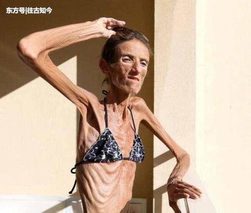 女子身高1.73米, 体重只有50斤, 廋成了一具“干尸”