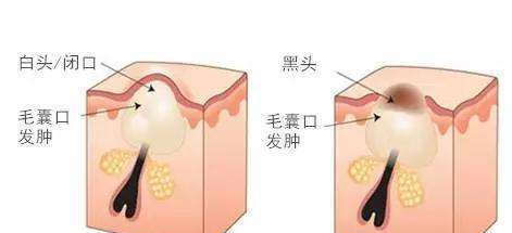 究竟■下巴上冒出白色颗粒,感觉像发脓,究竟是什么东西?怎么消下去?