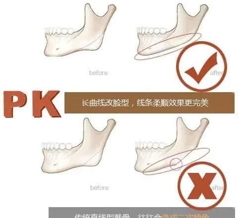 「神经血管」最高级别的整形手术,你知道吗?