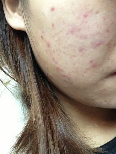 睡醒后脸上出现3个小窍门，证明毛孔里积满了螨虫，已经溢出来了