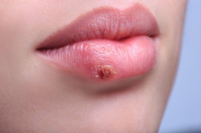 【图】嘴角疱疹会经常复发吗 不注意保护的话