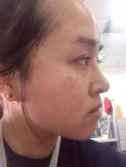 脸上出现此现象，说明螨虫埋头在毛孔里打洞！3妙招可解决