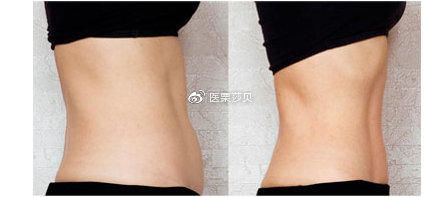  「脂手术」腹部吸脂后小肚子发硬正常吗