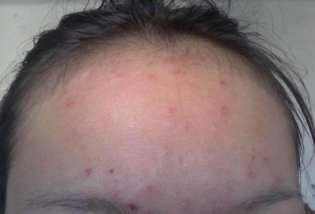 脸上起这种疙瘩, 会痒, 抓破后还能掉出硬邦邦米粒, 居然是这3物