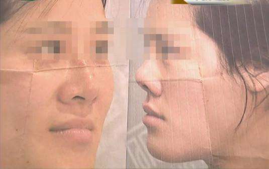 女子花了五万元整容, 结果做成了猪鼻子, 网友: 承包了我一年的笑