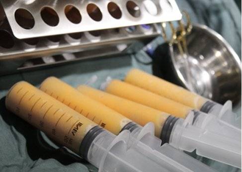 韦元强:女人面部凹陷为什么会显老?