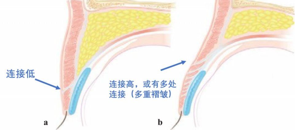 双眼皮“黄金不败宽度”来了!某璐要是早看到也不至于割完眼皮又