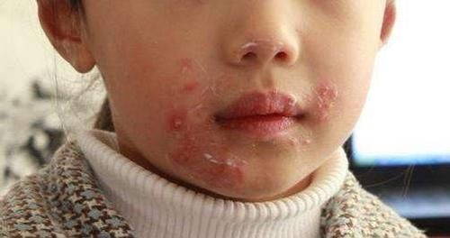  「孩子」孩子出现这几个症状，是缺锌了！影响身高和智力，再不重视就晚了