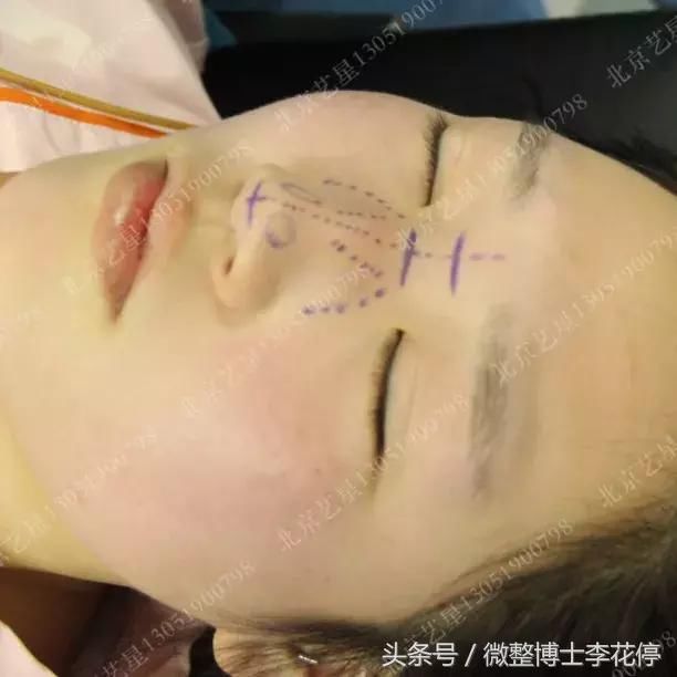 实锤：国民闺女，整容了？