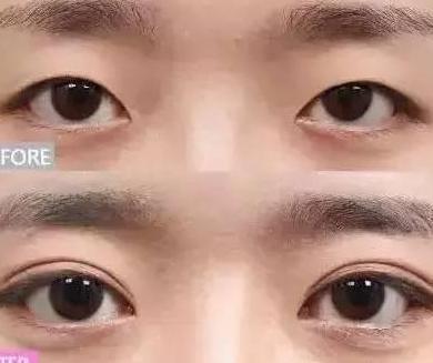 一双眼睛毁掉整张脸，这几种眼睛做双眼皮美爆了，有你没有？