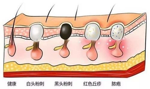 「 黑头」皮肤科医生教你一招，让黑头自动流出来，鼻上黑头别傻傻再用手挤