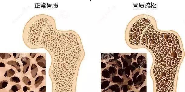  预防骨质：身上出现这4种症状，八成骨质疏松了，家里有老年人的不妨多注意