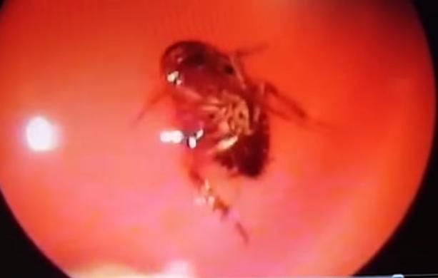 妇女直喊头疼前去检查,发现是脑袋内进了一只