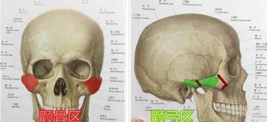  『事儿』颧骨颧弓整形那些事儿