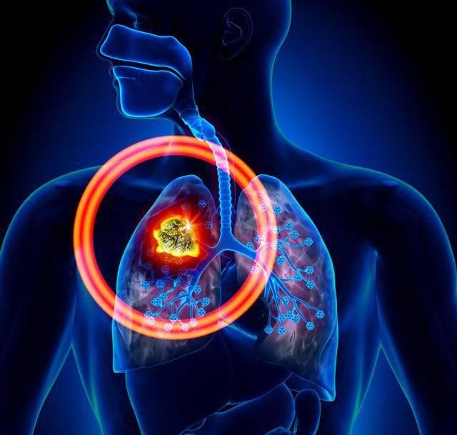  「良性」我们说肿瘤有良性和恶性之分，“肺癌”早期，这几个症状可能会提醒你