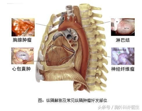 晚期纵隔肿瘤会有哪些症状?怎么办?