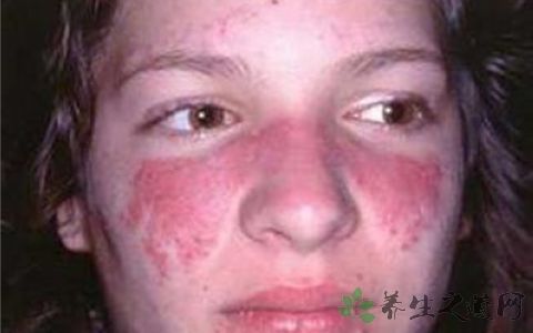 红斑狼疮是否属于传染疾病