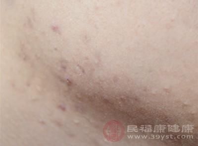  #痘印#去痘印的方法 激光能帮助缓解这个问题