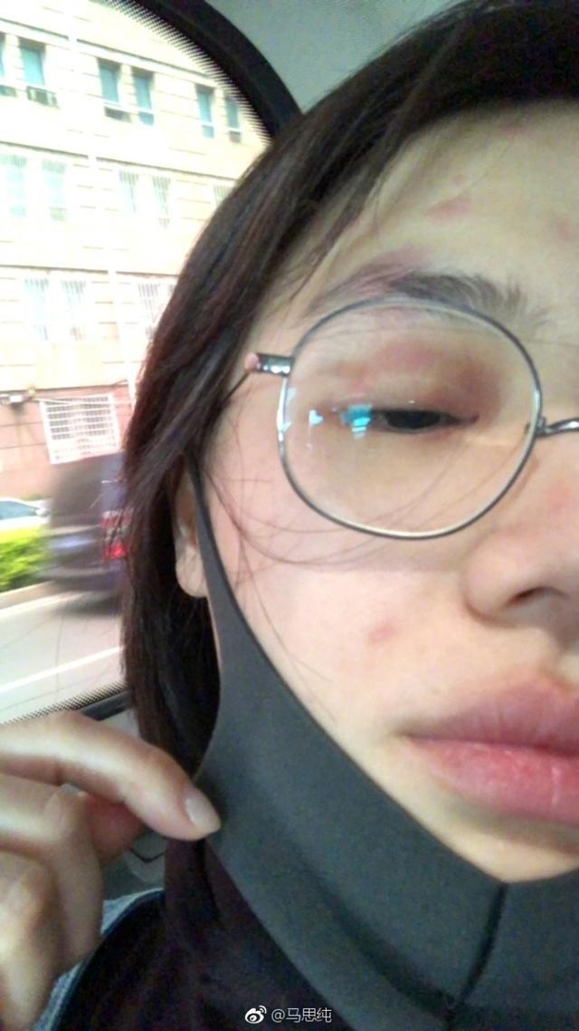 马思纯患带状疱疹微博晒素颜 周冬雨:你明天 就
