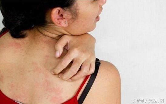 螨虫在后背疯狂爆发会有4迹象，坚持用3招一脚“踹飞”螨虫