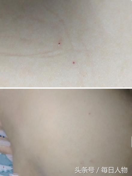 甘肃幼儿园发生疑似针扎孩子事件 两名涉事员工已调离岗位