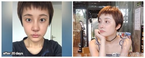 #瘢痕增生#术后恢复期很重要的三个阶段,需要如何进行护理?