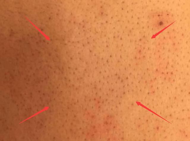 后背有这3个表现，暗示毛孔内螨虫过多，3方法轻松清走“垃圾”