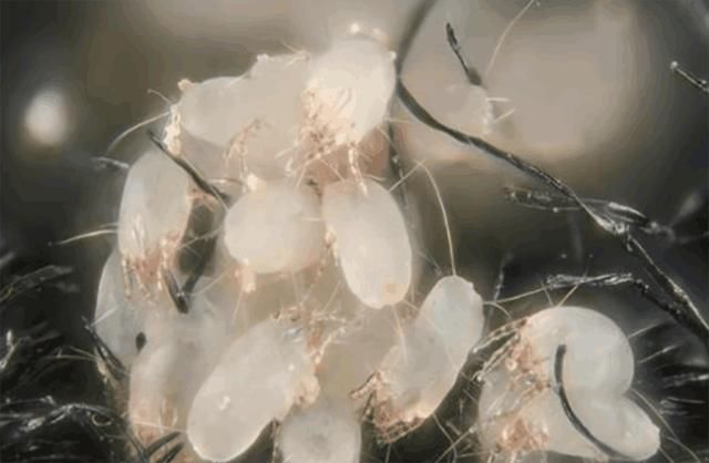 螨虫又脏又臭，脸上会有4大警报，三招让上万螨虫有来无回