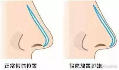 『医生』关于隆鼻术后假体偏斜的原因,你知道吗?