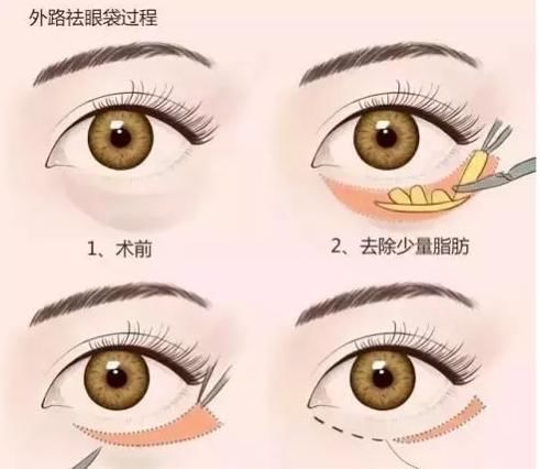  「恢复期」优质解答眼袋外切手术恢复期多久，手术去眼袋后会复发吗？