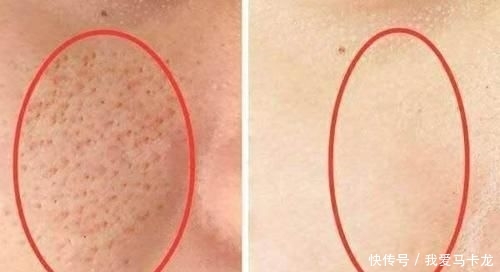  「毛孔粗大」女生脸上毛孔大到能插秧？教你3个小窍门，助你皮肤Q弹似果冻