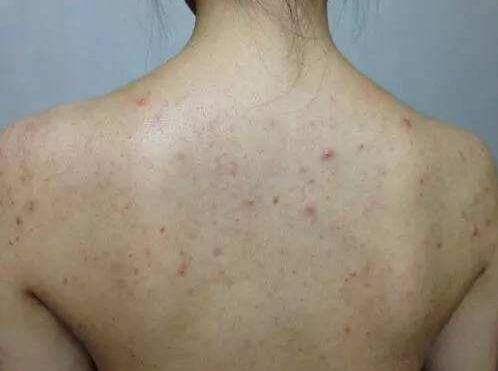 后背有痘痘需要除螨，及早知道2招能“消灭”