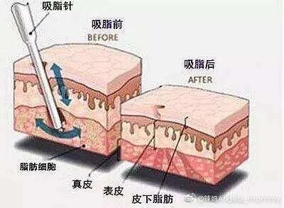  「影响」#知识·问答#抽脂手术是否影响重疾核保?
