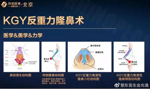 『医生』关于隆鼻术后假体偏斜的原因,你知道吗?