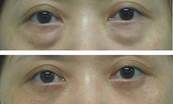 109岁姥姥告诉我:药店不起眼一药膏，敷上皱纹、眼袋都消失