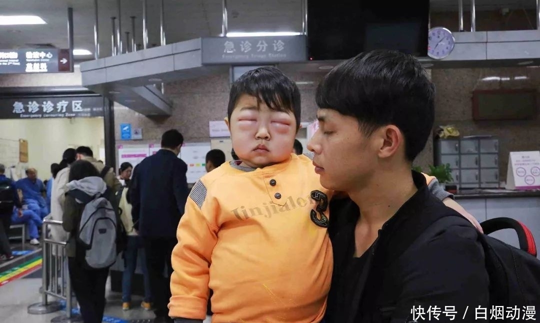「发病」4岁男童患怪病病好时帅帅的,发病时肚大像怀孕双眼只剩一条线!
